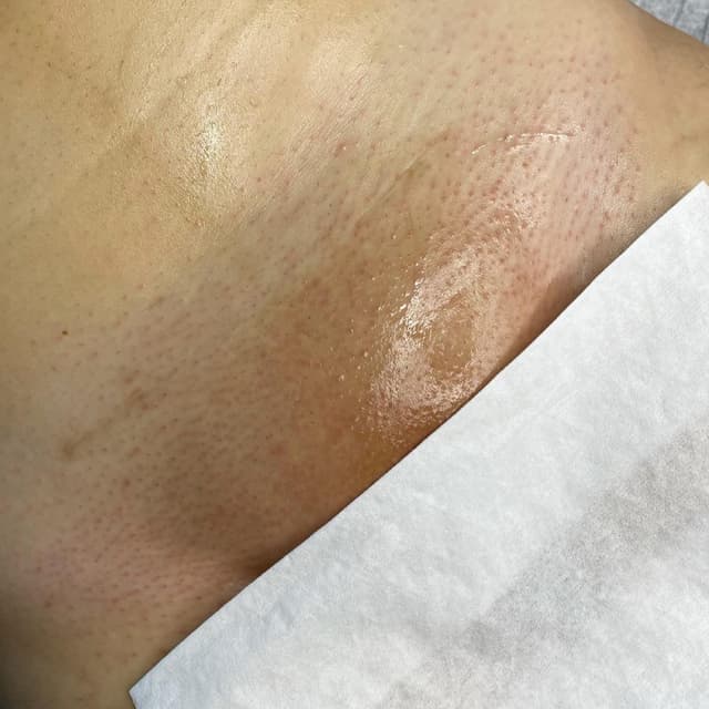 6-Month Smooth Skin Package at TrueSkin By Knicole in Orlando, FL